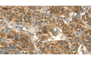 Immunohistochemistry of paraffin-embedded Human liver cancer using HSD17B8 Polyclonal Antibody at dilution of 1:55 (HSD17B8 antibody)