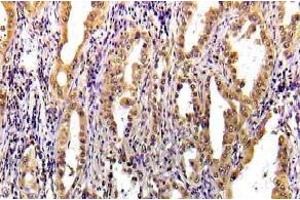 Immunohistochemistry (IHC) analyzes of STAT3 pAb in paraffin-embedded human lung carcinoma tissue. (STAT3 antibody)