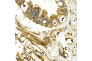 Immunohistochemistry of paraffin-embedded human liver cancer using GBP1 antibody (ABIN6293142) at dilution of 1:100 (40x lens). (GBP1 antibody)