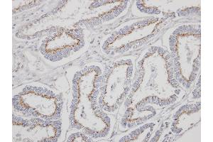 Immunohistochemical staining of paraffin-embedded Endometrial CA using YIPF4 antibody at a dilution of 1:500 (YIPF4 antibody)
