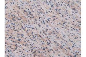 IHC-P analysis of Human Prostate Gland Cancer Tissue, with DAB staining. (CD147 antibody  (AA 79-280))