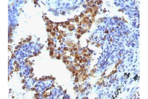 Formalin-fixed, paraffin-embedded human Lung Adenocarcinoma stained with Napsin-A Monoclonal Antibody (NAPSA/1238 + NAPSA/1239). (NAPSA antibody  (AA 189-299))