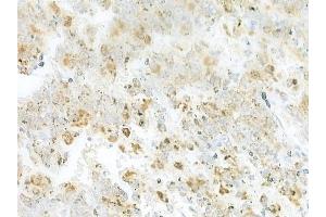 ABIN6264754 and ABIN6273309 at 1/100 staining human melanoma by IHC-P.