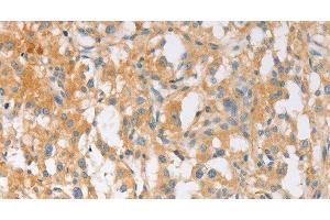 Immunohistochemistry of paraffin-embedded Human thyroid cancer using EPS15L1 Polyclonal Antibody at dilution of 1:30 (EPS15L1 antibody)
