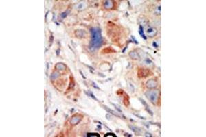 Formalin-fixed and paraffin-embedded human cancer tissue reacted with the primary antibody, which was peroxidase-conjugated to the secondary antibody, followed by DAB staining. (PIK3CD antibody  (C-Term))