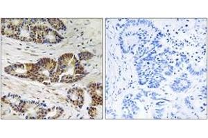 Immunohistochemistry analysis of paraffin-embedded human colon carcinoma tissue, using GRK2 (Ab-685) Antibody. (GRK2 antibody  (AA 640-689))