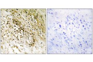 Immunohistochemistry analysis of paraffin-embedded human prostate carcinoma tissue, using PDZD2 antibody.