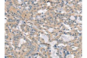 The image on the left is immunohistochemistry of paraffin-embedded Human thyroid cancer tissue using ABIN7192520(SLC6A8 Antibody) at dilution 1/30, on the right is treated with synthetic peptide. (SLC6A8 antibody)