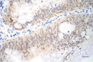 Immunohistochemistry was performed on paraffin-embedded human sigmoid colon carcinoma using p21 antibody (ABIN7798222), 1:200). (Recombinant p21 antibody)