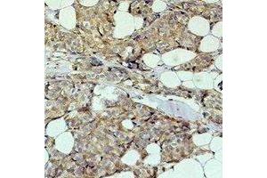 Immunohistochemical analysis of HER2 staining in human breast cancer formalin fixed paraffin embedded tissue section. (ErbB2/Her2 antibody)