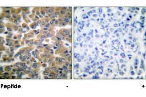 Immunohistochemical analysis of paraffin-embedded human breast carcinoma tissue using NR3C1 polyclonal antibody . (Glucocorticoid Receptor antibody)