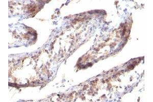 Formalin-fixed, paraffin-embedded human Testicular Carcinoma stained with TGF alpha Mouse Monoclonal Antibody (SPM357) (TGFA antibody  (C-Term))