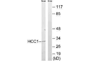 Immunohistochemistry analysis of paraffin-embedded human breast carcinoma tissue, using HCC1 antibody.