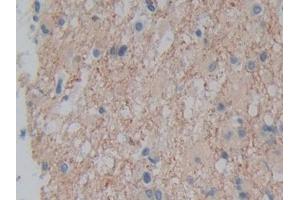 DAB staining on IHC-P; Samples: Human Glioma Tissue (Plexin A1 antibody  (AA 43-300))