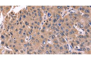 Immunohistochemistry of paraffin-embedded Human liver cancer tissue using CSNK1D Polyclonal Antibody at dilution 1:50 (Casein Kinase 1 delta antibody)