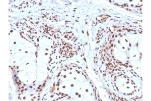 Formalin-fixed, paraffin-embedded human Basal Cell Carcinoma stained with Nucleophosmin Mouse Monoclonal Antibody (NPM1/3286). (NPM1 antibody  (AA 185-287))