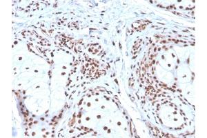 Formalin-fixed, paraffin-embedded human Basal Cell Carcinoma stained with Nucleophosmin Mouse Monoclonal Antibody (NPM1/3286).