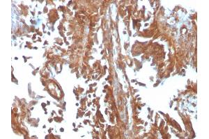 Formalin-fixed, paraffin-embedded human Urothelial Carcinoma stained with PAI-RBP1 Mouse Monoclonal Antibody (SERBP1/3497).