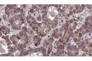 ABIN6273900 at 1/100 staining Human liver cancer tissue by IHC-P. (Purinergic Receptor P2Y, G-Protein Coupled, 13 (P2RY13) (C-Term) antibody)
