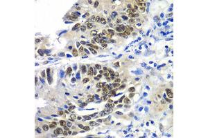 Immunohistochemistry of paraffin-embedded human colon carcinoma using DACH1 antibody at dilution of 1:100 (x40 lens). (DACH1 antibody)