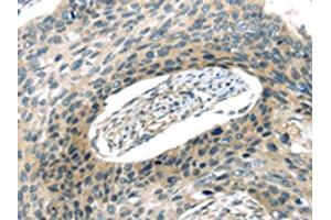The image on the left is immunohistochemistry of paraffin-embedded Human esophagus cancer tissue using ABIN7193008(VAMP2 Antibody) at dilution 1/20, on the right is treated with synthetic peptide. (VAMP2 antibody)