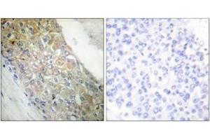Immunohistochemistry analysis of paraffin-embedded human breast carcinoma tissue, using IR (Ab-1355) Antibody.