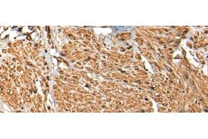Immunohistochemistry of paraffin-embedded Human prost ate cancer tissue using MICU1 Polyclonal Antibody at dilution of 1:35(x200) (MICU1 antibody)