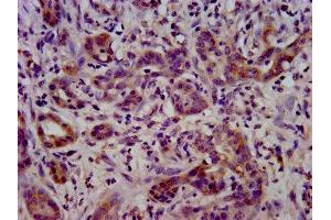 IHC image of ABIN7158426 diluted at 1:400 and staining in paraffin-embedded human pancreatic cancer performed on a Leica BondTM system. (LSR antibody  (AA 112-233))