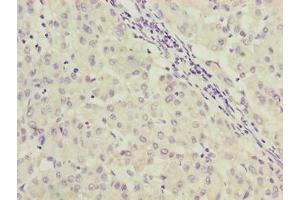 Immunohistochemistry of paraffin-embedded human liver cancer using ABIN7166922 at dilution of 1:100