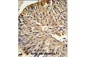 DHFR Antibody (C-term) (ABIN391566 and ABIN2841504) IHC analysis in formalin fixed and paraffin embedded human lung carcinoma followed by peroxidase conjugation of the secondary antibody and DAB staining. (Dihydrofolate Reductase antibody  (C-Term))