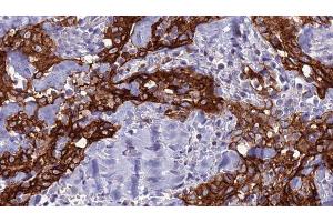 ABIN6277723 at 1/100 staining Human Head and neck cancer tissue by IHC-P.