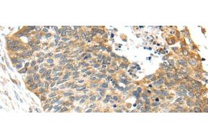 Immunohistochemistry of paraffin-embedded Human esophagus cancer tissue using TNFAIP8 Polyclonal Antibody at dilution 1:35 (TNFAIP8 antibody)