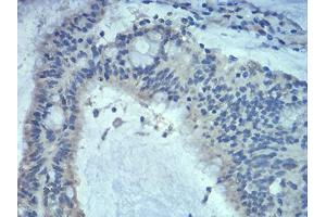 Immunohistochemical analysis of paraffin-embedded colon cancer tissues using Rab5a mouse mAb with DAB staining. (RAB5 antibody  (AA 1-215))