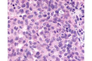 Anti-GPR98 / VLGR1 antibody IHC of human Ovary, Carcinoma. (ADGRV1 / GPR98 antibody  (N-Term))