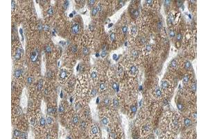 ABIN6266590 at 1/100 staining human liver carcinoma tissue sections by IHC-P. (MMP11 antibody  (N-Term))