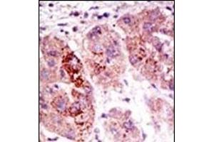 Formalin-fixed and paraffin-embedded human cancer tissue reacted with the primary antibody, which was peroxidase-conjugated to the secondary antibody, followed by AEC staining. (USP7 antibody  (C-Term))