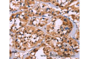 Immunohistochemistry of Human thyroid cancer using HIST1H1C Polyclonal Antibody at dilution of 1:70 (HIST1H1C antibody)