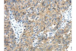 The image on the left is immunohistochemistry of paraffin-embedded Human breast cancer tissue using ABIN7131402(TMPRSS13 Antibody) at dilution 1/30, on the right is treated with fusion protein.