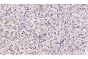 ABIN6278027 at 1/100 staining Human melanoma tissue by IHC-P. (FGA antibody  (C-Term))