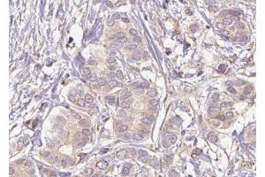 ABIN6275873 at 1/100 staining Human breast cancer tissue by IHC-P. (HMMR antibody  (Internal Region))