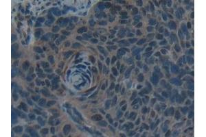 Detection of Hepc in Human Esophagus cancer Tissue using Polyclonal Antibody to Hepcidin (Hepc) (Hepcidin antibody  (AA 25-84))