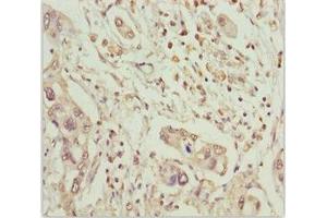 Immunohistochemistry of paraffin-embedded human pancreatic cancer using ABIN7159626 at dilution of 1:100 (MCCC2 antibody  (AA 284-563))
