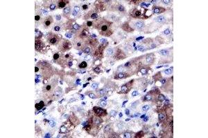 Immunohistochemical analysis of XPC staining in human liver cancer formalin fixed paraffin embedded tissue section. (XPC antibody)