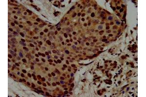 IHC image of ABIN7168396 diluted at 1:500 and staining in paraffin-embedded human pancreatic cancer performed on a Leica BondTM system. (Raly antibody  (AA 254-306))