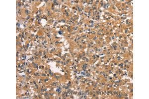 Immunohistochemistry of Human thyroid cancer using DNM2 Polyclonal Antibody at dilution of 1:40