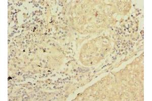 Immunohistochemistry of paraffin-embedded human lung cancer using ABIN7166622 at dilution of 1:100 (Surfactant Protein C antibody  (AA 24-58))