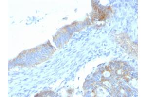 Formalin-fixed, paraffin-embedded human Colon Carcinoma stained with Heparan Sulfate Monoclonal Antibody (SPM255). (HSPG2 antibody)