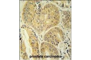 EN Antibody (C-term) (ABIN652020 and ABIN2840500) immunohistochemistry analysis in formalin fixed and paraffin embedded human prostate carcinoma followed by peroxidase conjugation of the secondary antibody and DAB staining. (Enamelin antibody  (C-Term))