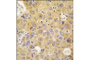 Formalin-fixed and paraffin-embedded human hepatocarcinoma tissue reacted with AARS antibody (N-term), which was peroxidase-conjugated to the secondary antibody, followed by DAB staining. (AARS antibody  (N-Term))