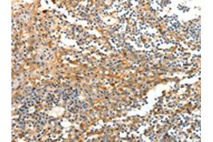The image on the left is immunohistochemistry of paraffin-embedded Human tonsil tissue using ABIN7129267(DTX3 Antibody) at dilution 1/20, on the right is treated with fusion protein. (Deltex Homolog 3 antibody)